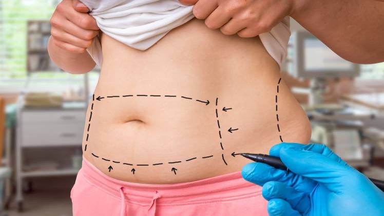 Is tummy tuck surgery worth your money